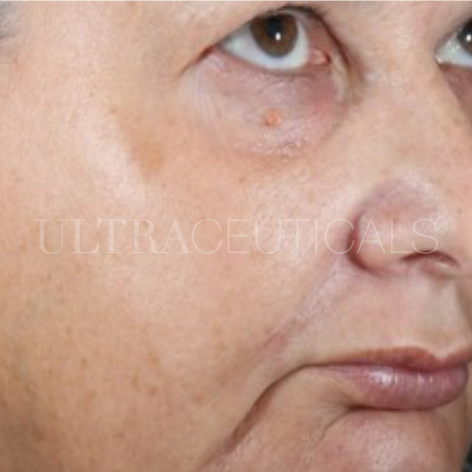 Ultraceuticals real visible results uneven complexion and pores