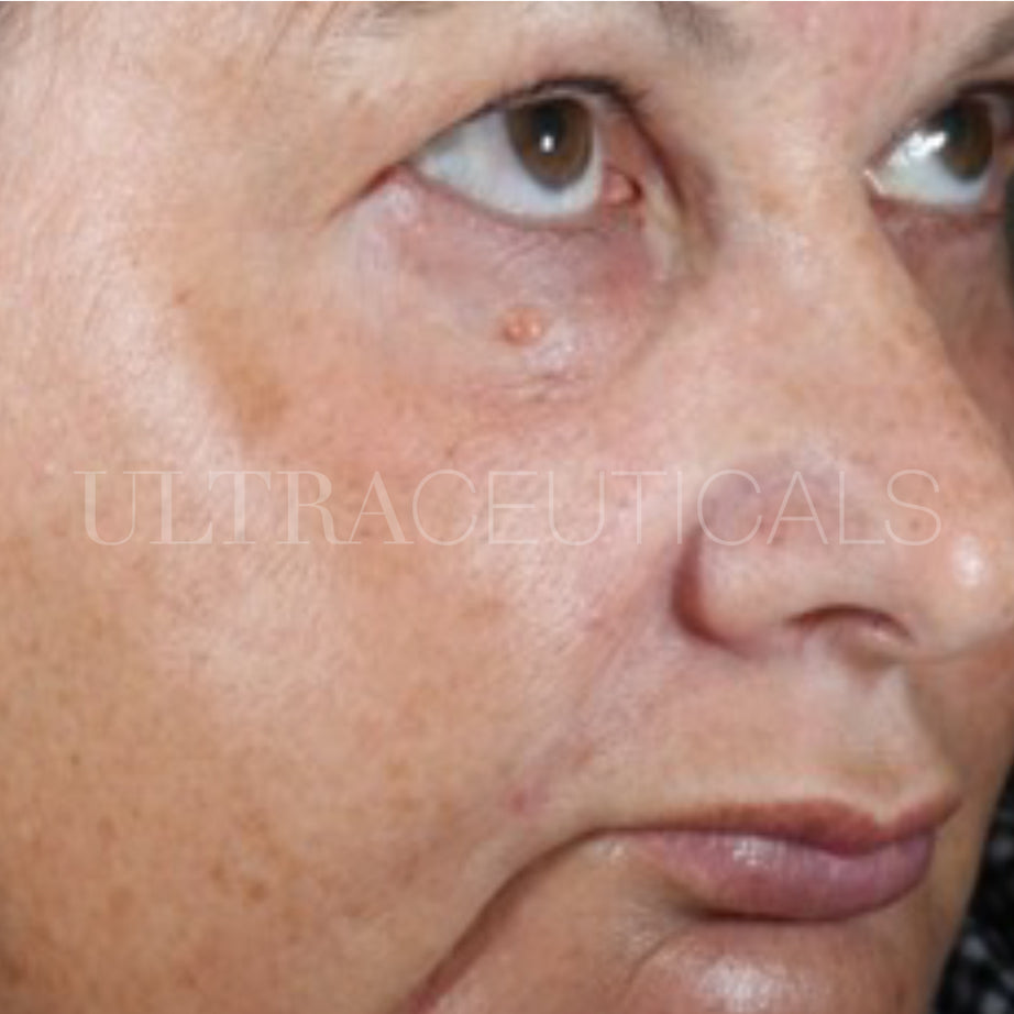 Ultraceuticals real visible results uneven complexion and pores