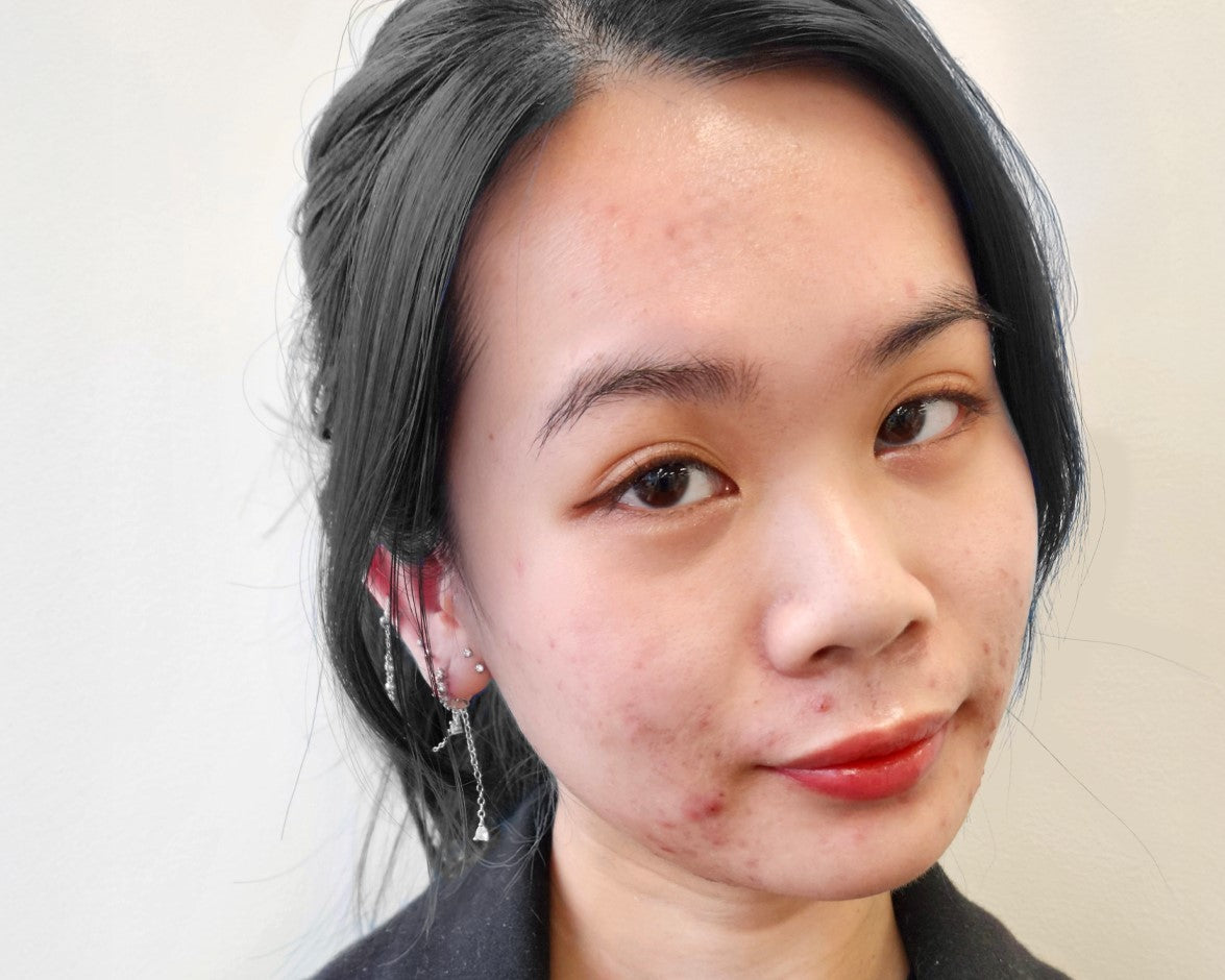 blog - how i got my adult acne under control