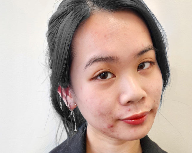 blog - how i got my adult acne under control