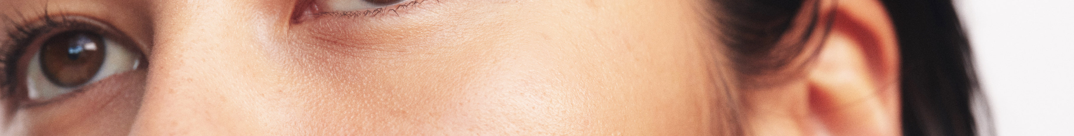 acne and congestion skin